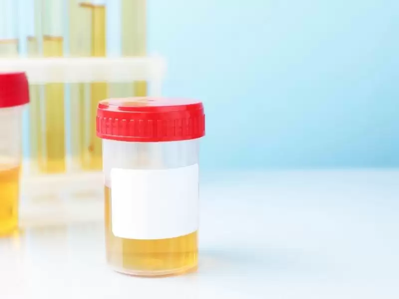 idrarda-kan-hematuri-nedir-neden-olur-ne-zaman-ciddi-olur