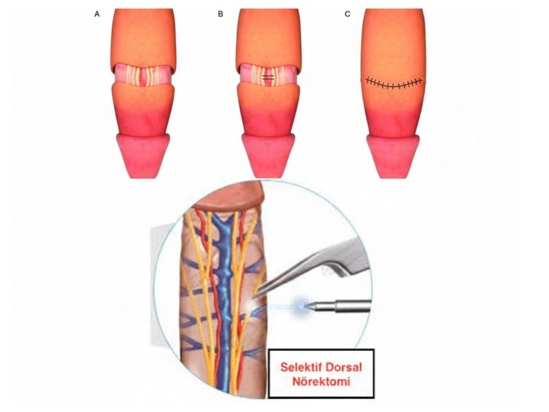 erken-bosalma-ameliyati-sonuclari-ve-iyilesme-sureci