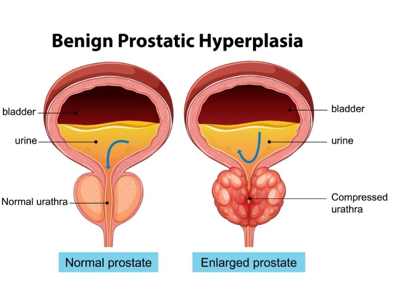 iyi-huylu-prostat-buyumesi-belirtileri-nelerdir