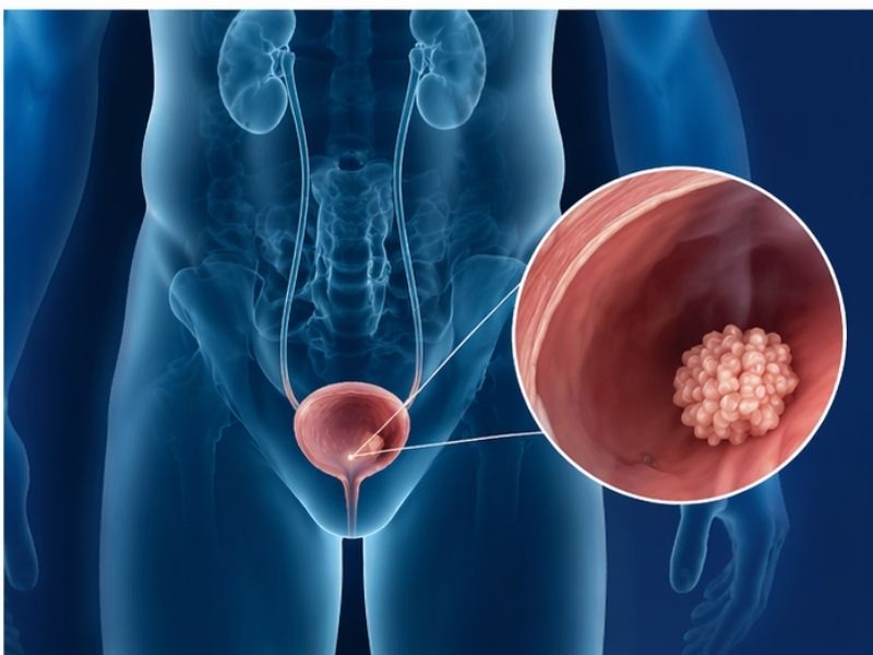 mesane-kanseri-kimlerde-daha-sik-gorulur