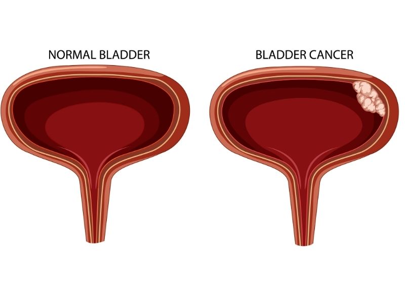 radikal-sistektomi-mesane-alinmasi-ameliyati-nedir