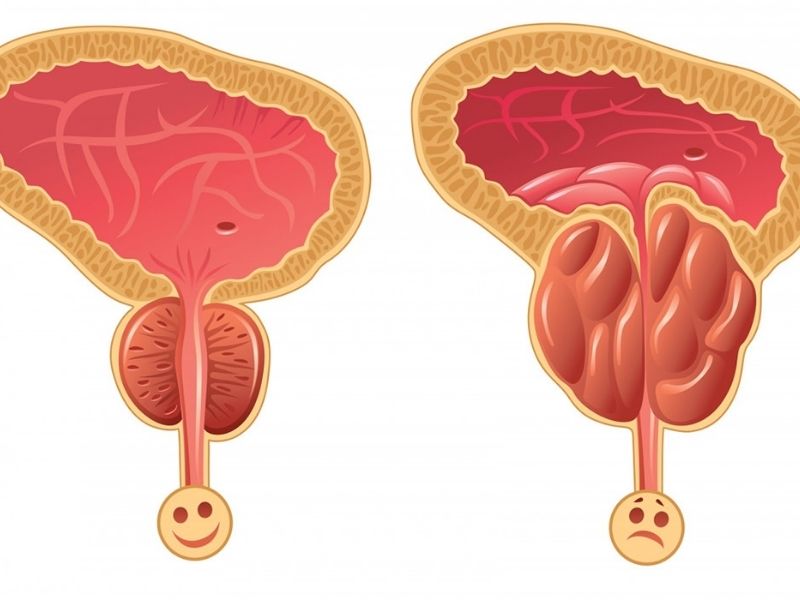 rezum-tedavisi-hangi-hastalar-icin-uygundur