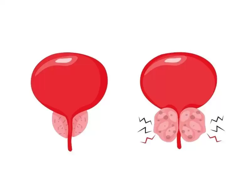 iyi-huylu-prostat-buyumesinde-size-en-uygun-yontem-hangisi