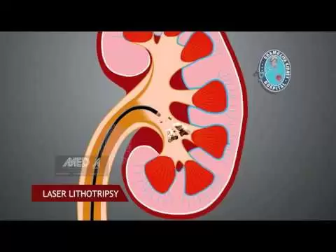 RIRS procedure [Kidny Stone]