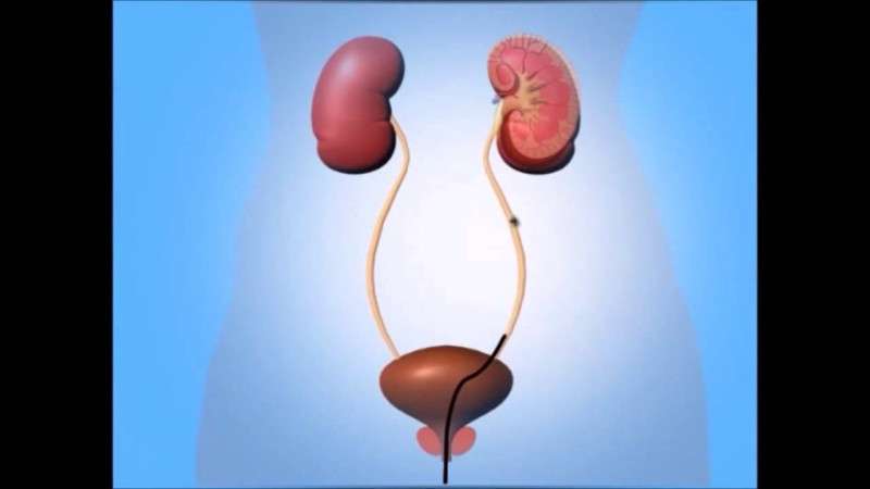 Kidney Stone Treatment-hyderabad best urologist and andrologist,best urologist,andrologist