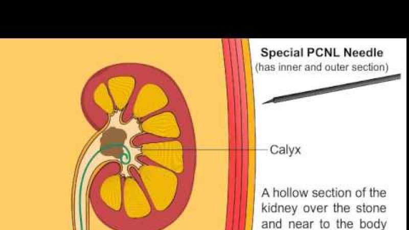 multimedia Percutaneous Pephrolithotomy,animation Percutaneous Nephrolithotomy,multimedia PCNL,animation PCNL