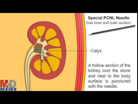 Percutaneous Nephrolithotomy