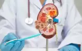 Böbrek Kanseri Nedir? Belirtileri ve Tedavi Seçenekleri
